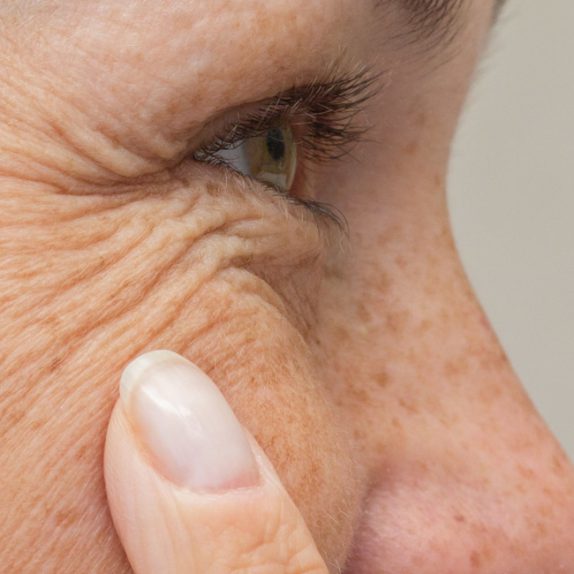 Facial Lines & Wrinkles