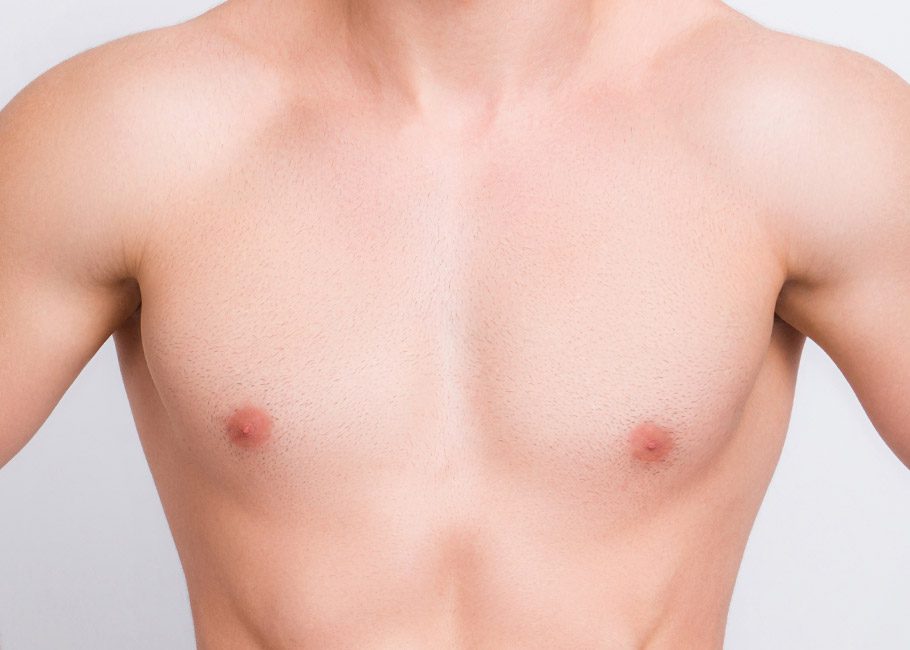 Gynaecomastia
