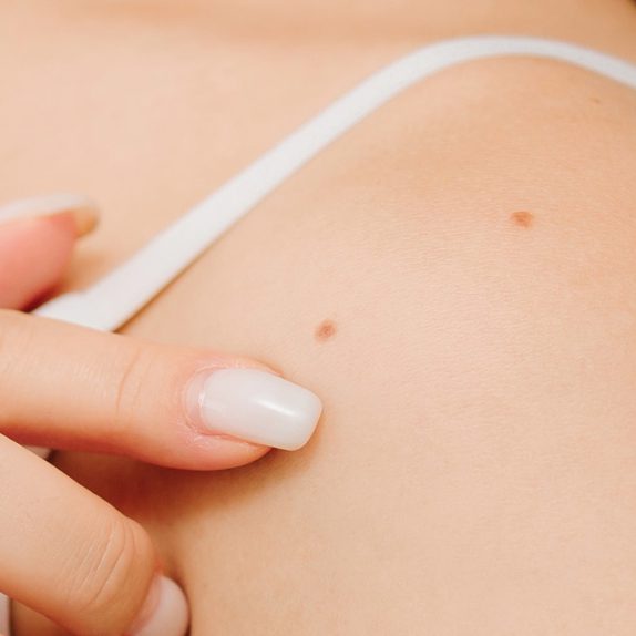 Mole Removal