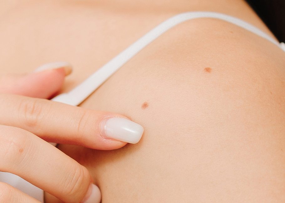 Mole Removal
