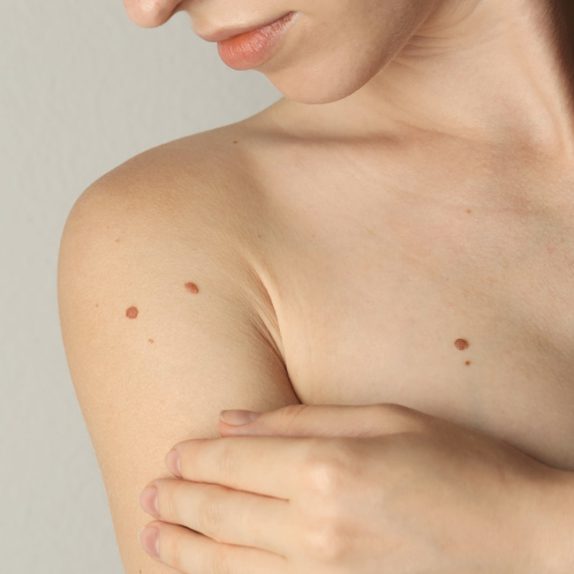 Skin Cancer Removal