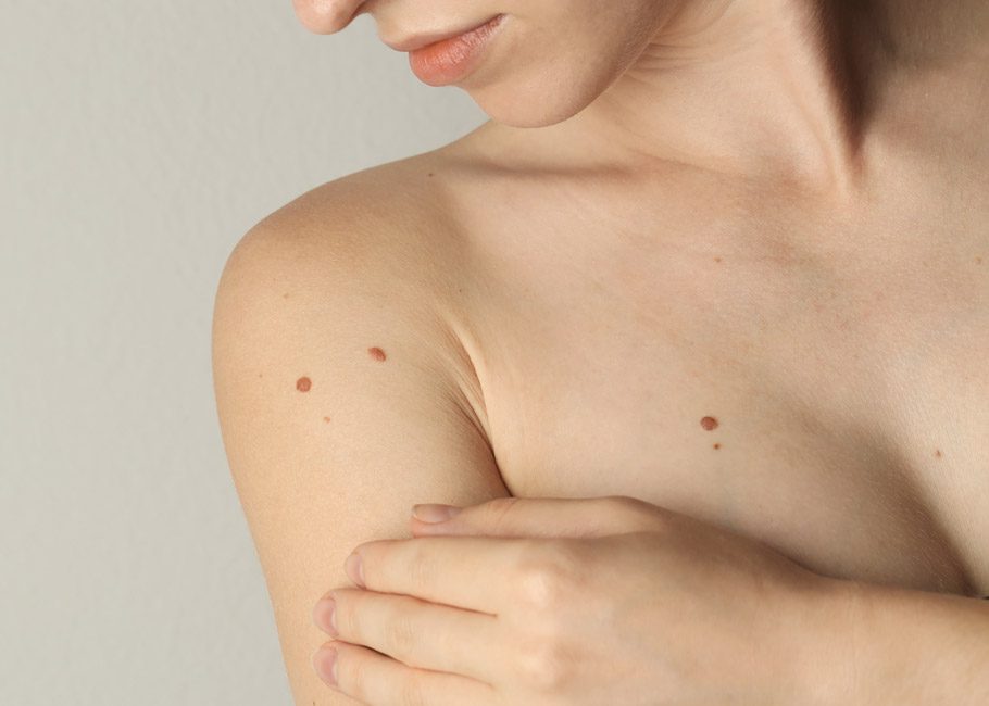 Skin Cancer Removal
