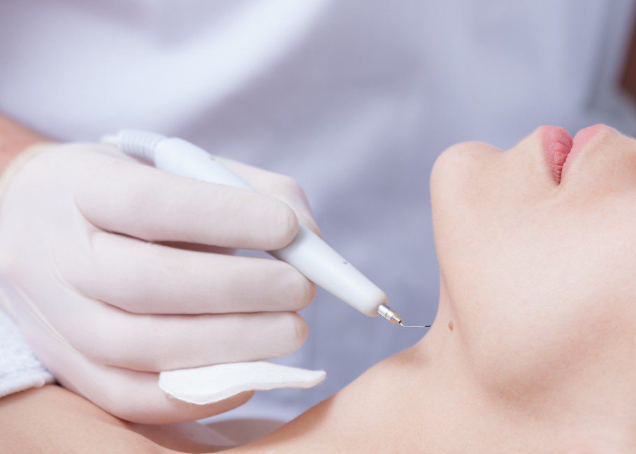 Warts and Verrucae Removal