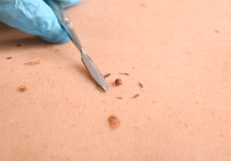 Curettage Cautery Kirbha Clinic
