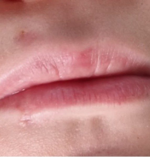Mole Removal After