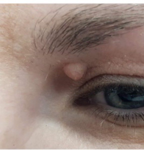 Mole Removal Before Kirbha Clinic